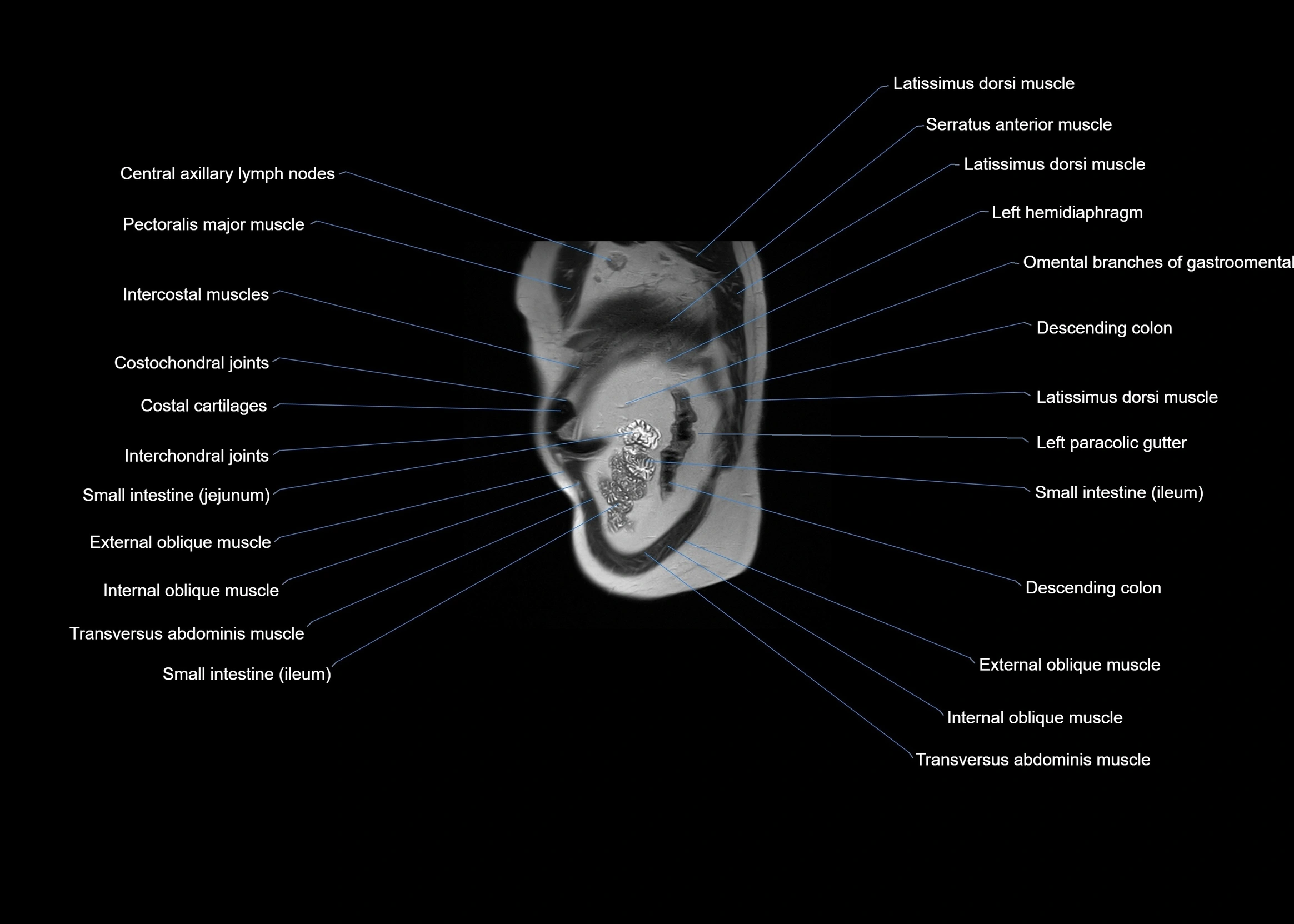 MRI abdomen sagittal cross sectional anatomy  radiology  image-img-00001-00063.webp